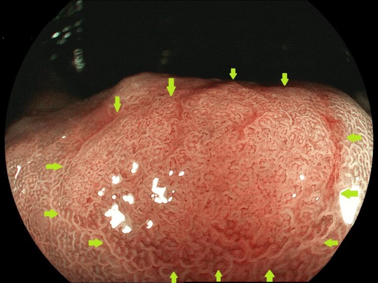 大腸腺腫(Colon adenoma)