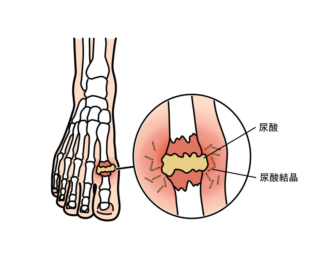 痛風発作