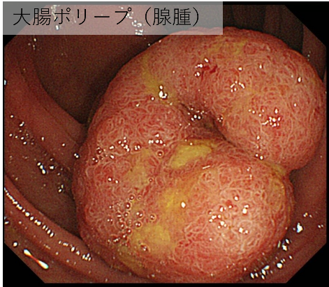 大腸ポリープ