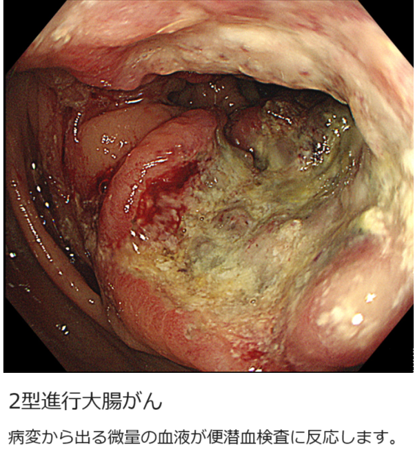 進行大腸がん(advanced colon cancer)