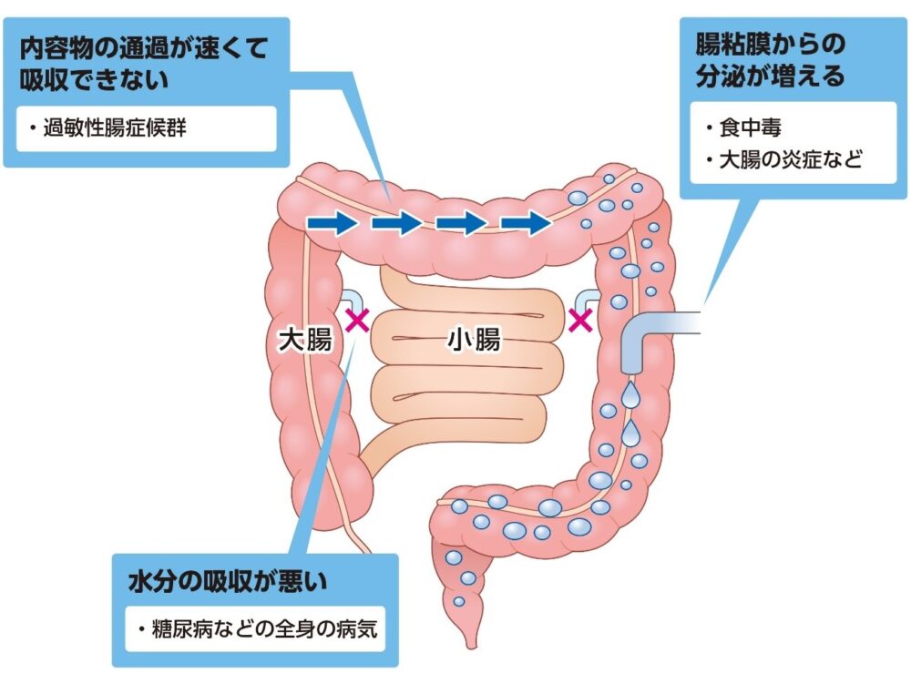 下痢を起こす機序