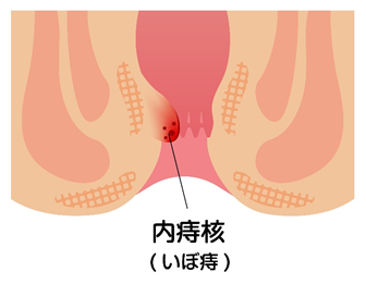 内痔核