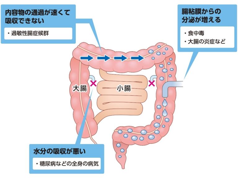 4タイプに分かれる下痢
