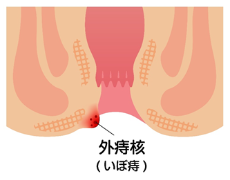 外痔核