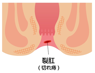 切れ痔（裂肛）