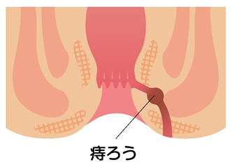 痔ろう